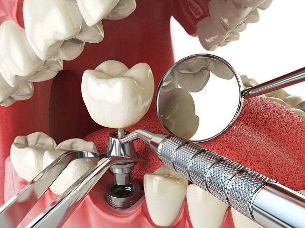 Best Emergency Treatment for Dental Infections or Abscesses in Amsterdam, NY